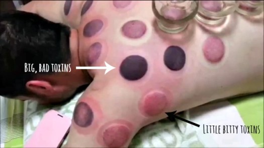 chinese cupping